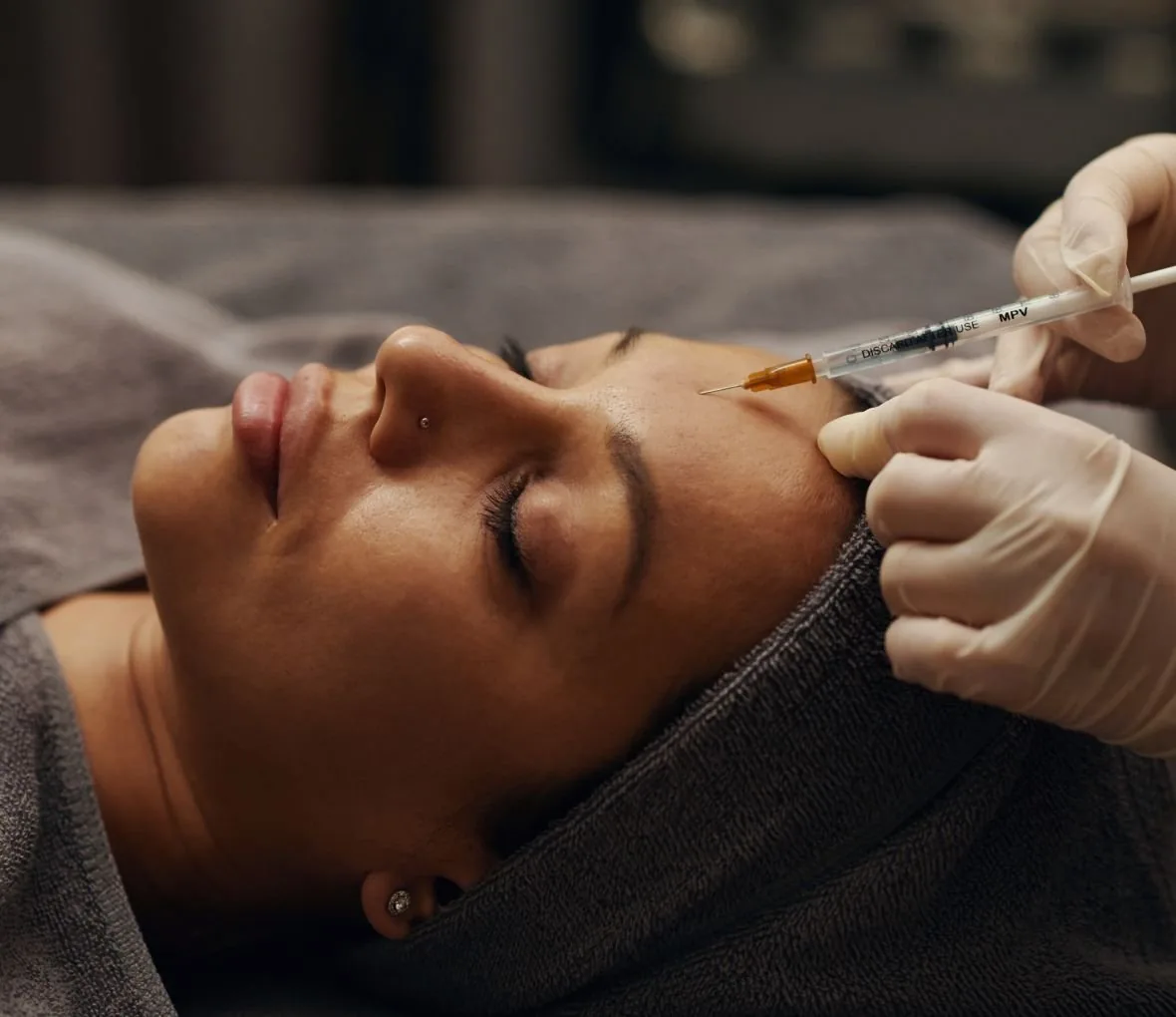 A lip filler treatment in progress