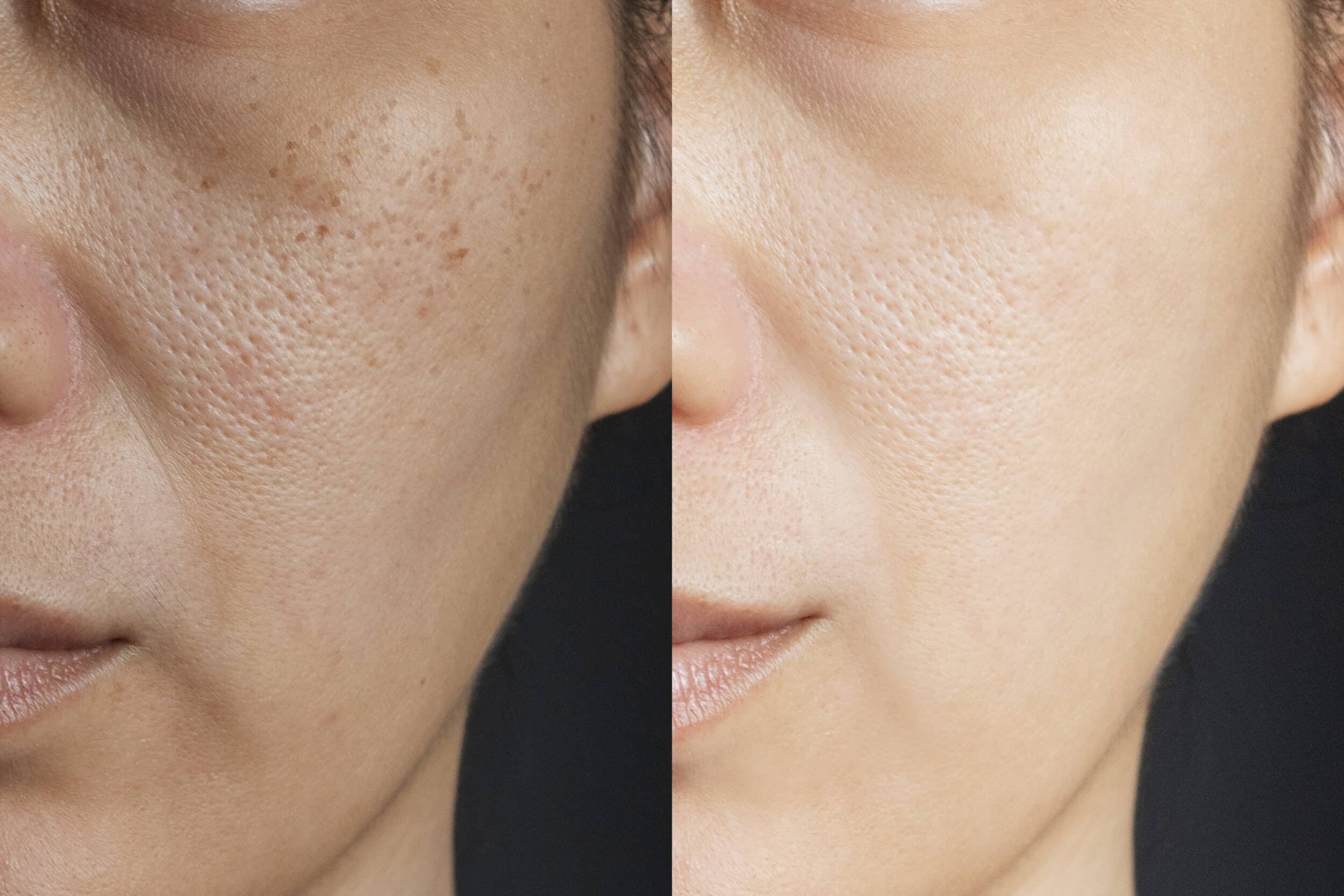 two pictures compare effect Before and After treatment. skin wit