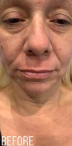 Before Image: Injectables