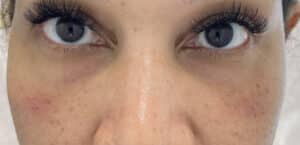 After Image: Injectables