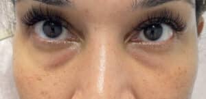 Before Image: Injectables