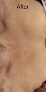 After Image: IPL Photofacial